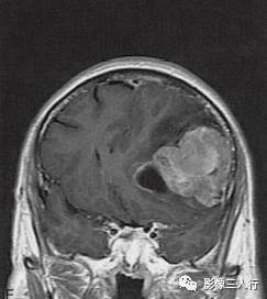 【病例】胶质母细胞瘤1例MR影像表现
