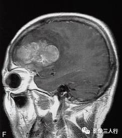 【病例】胶质母细胞瘤1例MR影像表现