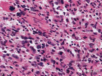 【病例】胶质母细胞瘤1例MR影像表现