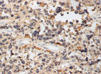 【病例】胶质母细胞瘤1例MR影像表现