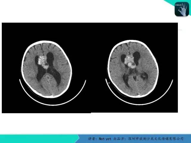 【病例】脑室内脉管瘤1例CT及MR影像诊断与鉴别