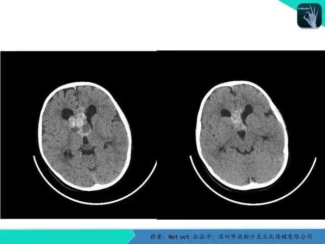 【病例】脑室内脉管瘤1例CT及MR影像诊断与鉴别