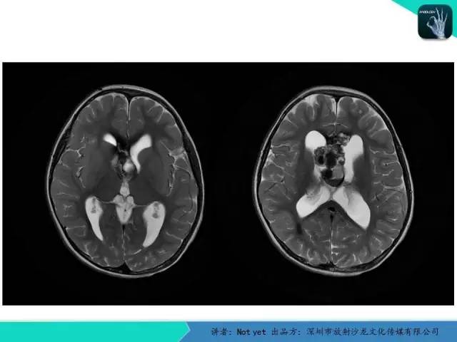 【病例】脑室内脉管瘤1例CT及MR影像诊断与鉴别