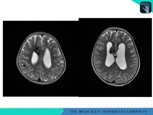 【病例】脑室内脉管瘤1例CT及MR影像诊断与鉴别