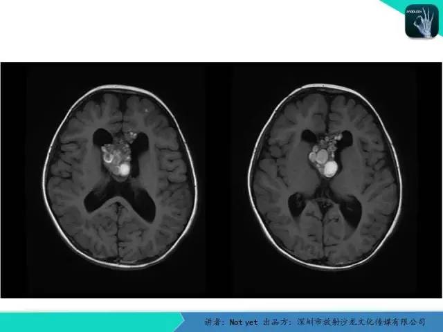 【病例】脑室内脉管瘤1例CT及MR影像诊断与鉴别