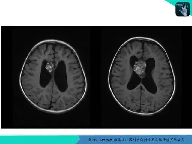 【病例】脑室内脉管瘤1例CT及MR影像诊断与鉴别