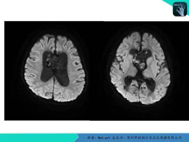 【病例】脑室内脉管瘤1例CT及MR影像诊断与鉴别