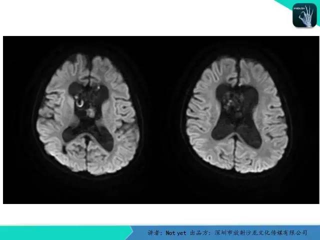 【病例】脑室内脉管瘤1例CT及MR影像诊断与鉴别