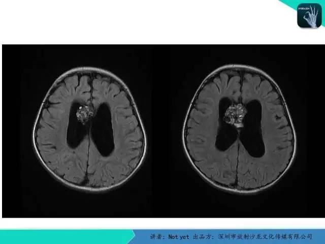 【病例】脑室内脉管瘤1例CT及MR影像诊断与鉴别