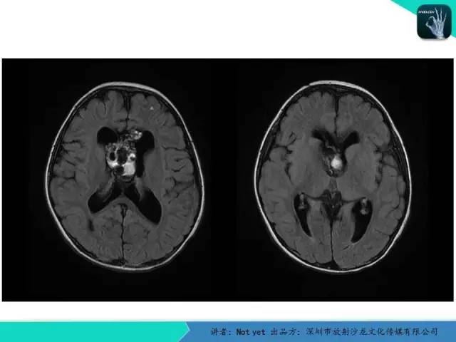 【病例】脑室内脉管瘤1例CT及MR影像诊断与鉴别