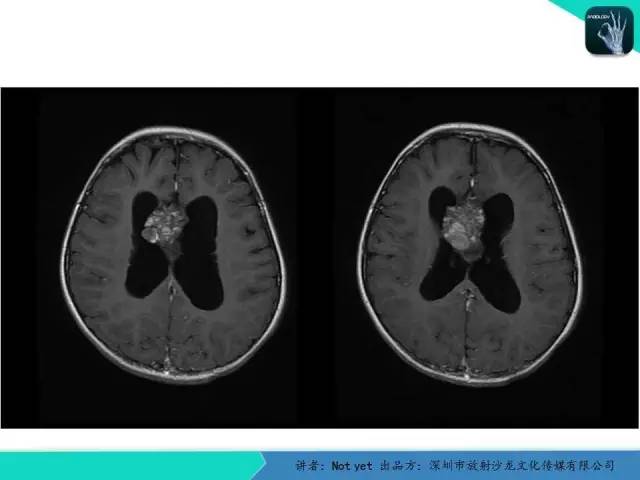 【病例】脑室内脉管瘤1例CT及MR影像诊断与鉴别