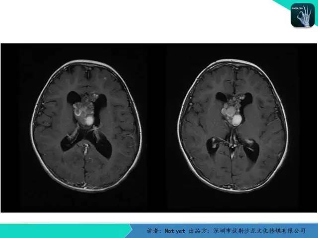 【病例】脑室内脉管瘤1例CT及MR影像诊断与鉴别