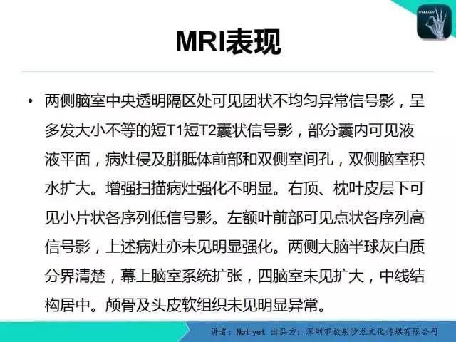 【病例】脑室内脉管瘤1例CT及MR影像诊断与鉴别