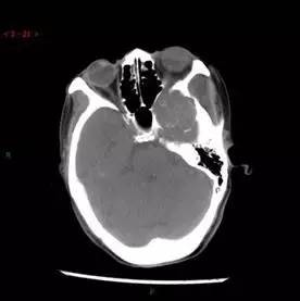 【病例】颞下窝区神经鞘瘤1例CT及MR影像表现