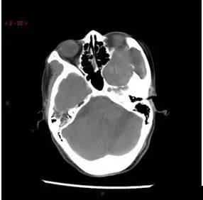 【病例】颞下窝区神经鞘瘤1例CT及MR影像表现