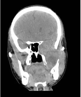 【病例】颞下窝区神经鞘瘤1例CT及MR影像表现