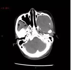 【病例】颞下窝区神经鞘瘤1例CT及MR影像表现