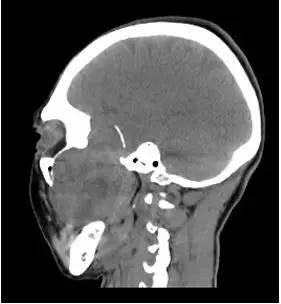 【病例】颞下窝区神经鞘瘤1例CT及MR影像表现