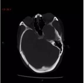 【病例】颞下窝区神经鞘瘤1例CT及MR影像表现