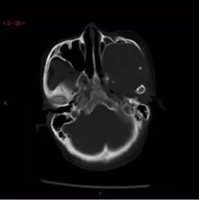 【病例】颞下窝区神经鞘瘤1例CT及MR影像表现
