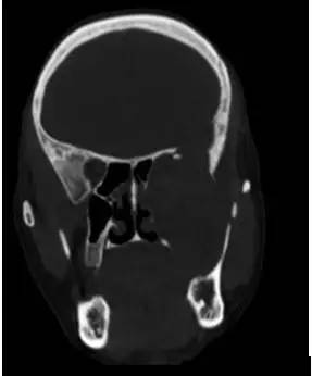 【病例】颞下窝区神经鞘瘤1例CT及MR影像表现