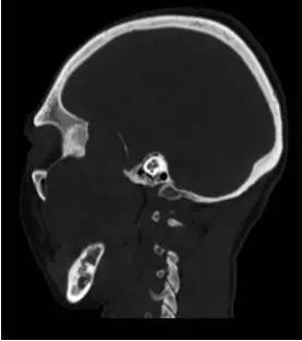 【病例】颞下窝区神经鞘瘤1例CT及MR影像表现