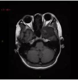【病例】颞下窝区神经鞘瘤1例CT及MR影像表现