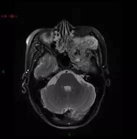 【病例】颞下窝区神经鞘瘤1例CT及MR影像表现