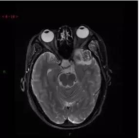 【病例】颞下窝区神经鞘瘤1例CT及MR影像表现