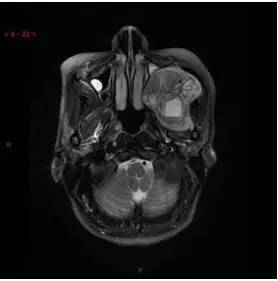 【病例】颞下窝区神经鞘瘤1例CT及MR影像表现