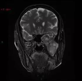 【病例】颞下窝区神经鞘瘤1例CT及MR影像表现