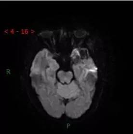 【病例】颞下窝区神经鞘瘤1例CT及MR影像表现