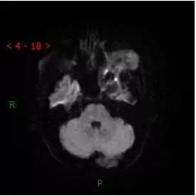 【病例】颞下窝区神经鞘瘤1例CT及MR影像表现