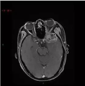 【病例】颞下窝区神经鞘瘤1例CT及MR影像表现