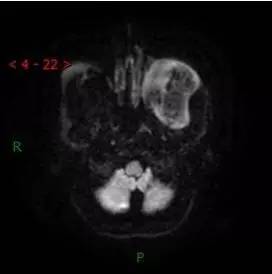 【病例】颞下窝区神经鞘瘤1例CT及MR影像表现