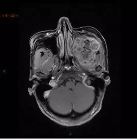 【病例】颞下窝区神经鞘瘤1例CT及MR影像表现