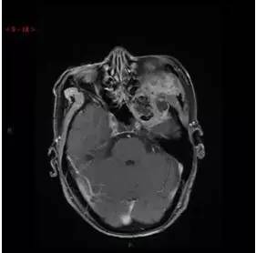 【病例】颞下窝区神经鞘瘤1例CT及MR影像表现