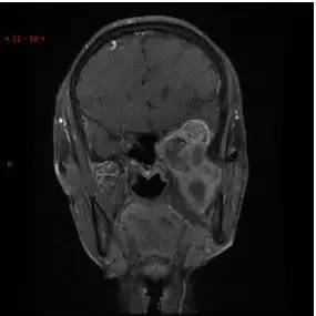 【病例】颞下窝区神经鞘瘤1例CT及MR影像表现