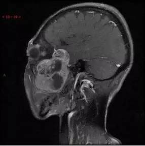 【病例】颞下窝区神经鞘瘤1例CT及MR影像表现