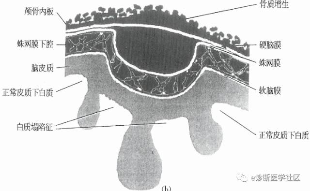 15种亚型脑膜瘤影像表现及诊断要点