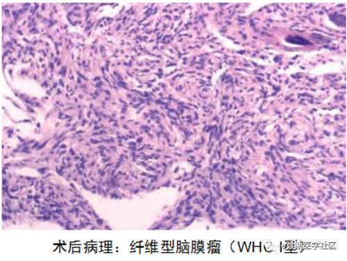15种亚型脑膜瘤影像表现及诊断要点