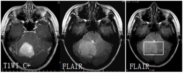 15种亚型脑膜瘤影像表现及诊断要点