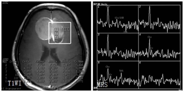 15种亚型脑膜瘤影像表现及诊断要点