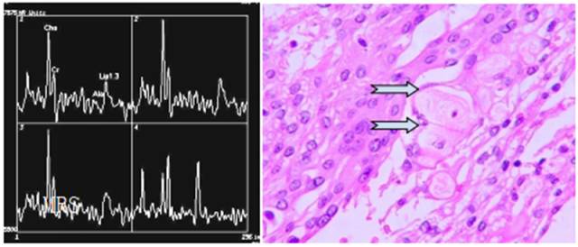 15种亚型脑膜瘤影像表现及诊断要点