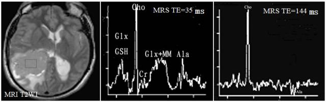 15种亚型脑膜瘤影像表现及诊断要点