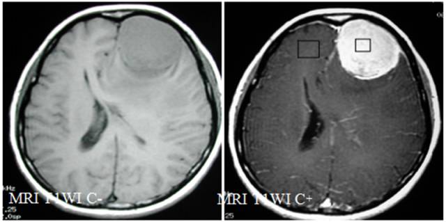 15种亚型脑膜瘤影像表现及诊断要点