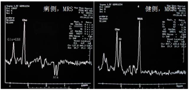 15种亚型脑膜瘤影像表现及诊断要点