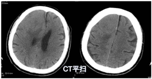 15种亚型脑膜瘤影像表现及诊断要点