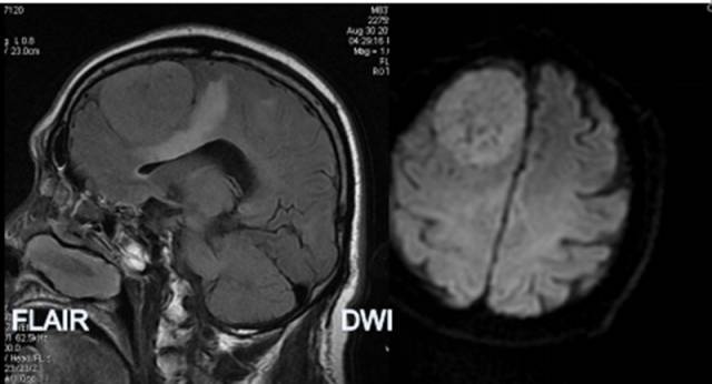 15种亚型脑膜瘤影像表现及诊断要点