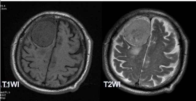 15种亚型脑膜瘤影像表现及诊断要点
